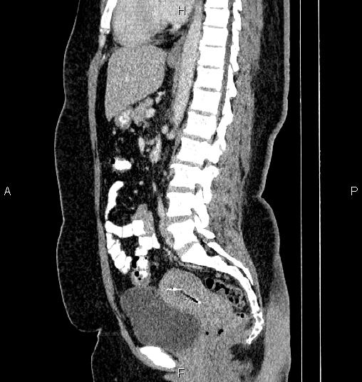 File:Bilateral ovarian dermoid cysts (Radiopaedia 85785-101603 D 50).jpg