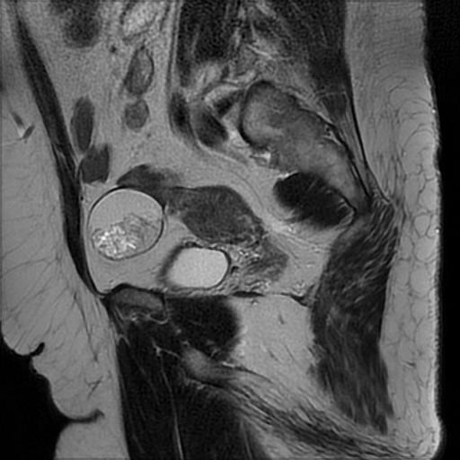 File:Bilateral ovarian dermoid cysts (Radiopaedia 90152-107338 Sagittal T2 18).jpg