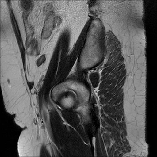 File:Bilateral ovarian dermoid cysts (Radiopaedia 90152-107338 Sagittal T2 24).jpg