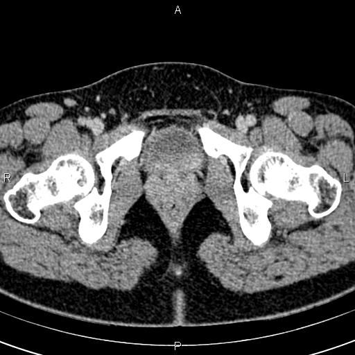 Bilateral ovarian teratoma (Radiopaedia 83131-97503 B 76).jpg