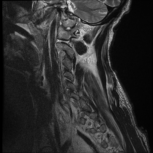 File:Bilateral perched facets with cord injury (Radiopaedia 45587-49714 Sagittal T2 15).jpg