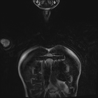 Bilateral spinoglenoid notch ganglion cysts (Radiopaedia 29577-30082 Coronal T2 5).jpg