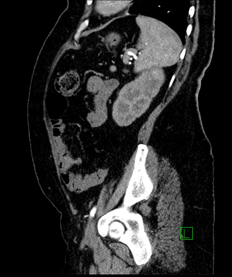 Bilateral sporadic synchronous clear cell renal cell carcinoma (Radiopaedia 85035-100575 E 38).jpg