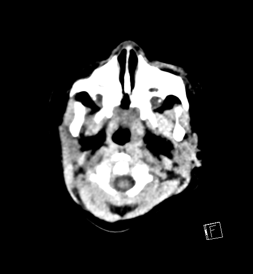 File:Bilateral subdural hemorrhage and parietal skull fracture (Radiopaedia 26058-26192 Axial non-contrast 25).png
