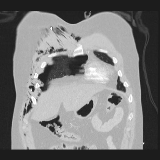 File:Bilateral traumatic renovascular injury (Radiopaedia 32051-32995 Coronal lung window 16).jpg