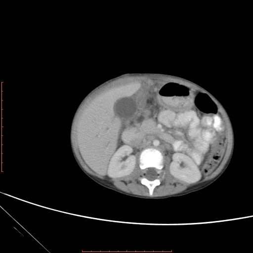 Biliary tract embryonal rhabdomyosarcoma (Radiopaedia 51815-57648 A 60).jpg
