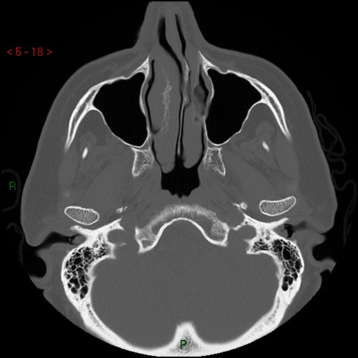 File:Bisphosphonate-related osteonecrosis of the jaw (Radiopaedia 54147-60329 Axial bone window 12).jpg