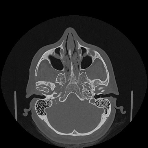File:Bisphosphonate-related osteonecrosis of the jaw (Radiopaedia 71324-81642 Axial bone window 154).jpg