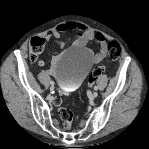 Bladder tumor detected on trauma CT (Radiopaedia 51809-57609 C 107).jpg