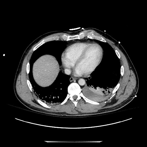 Blunt abdominal trauma with solid organ and musculoskelatal injury with active extravasation (Radiopaedia 68364-77895 A 6).jpg