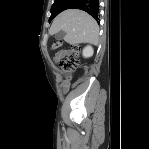 File:Blunt abdominal trauma with solid organ and musculoskelatal injury with active extravasation (Radiopaedia 68364-77895 C 41).jpg