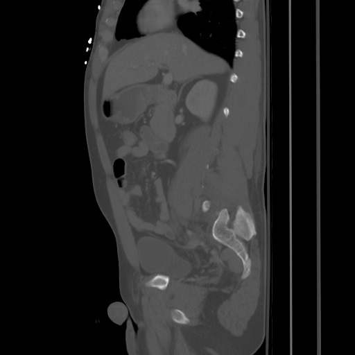 Blunt abdominal trauma with solid organ and musculoskelatal injury with active extravasation (Radiopaedia 68364-77895 Sagittal bone window 37).jpg
