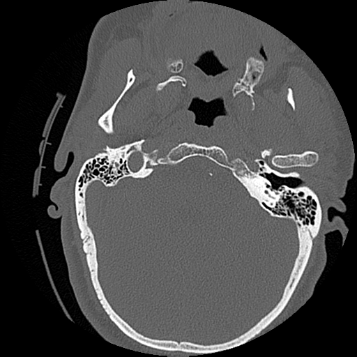 File:Blunt cerebrovascular injury (Radiopaedia 53682-59743 Axial bone window 7).png