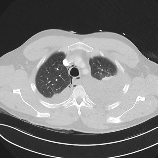 Boerhaave syndrome (Radiopaedia 39382-41660 Axial lung window 13).png