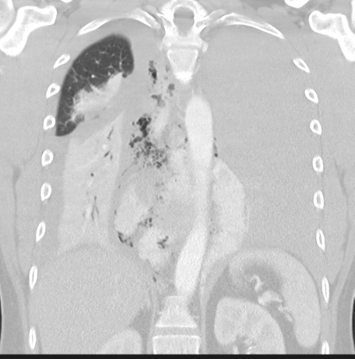 Boerhaave syndrome (Radiopaedia 39382-41661 Coronal lung window 33).png