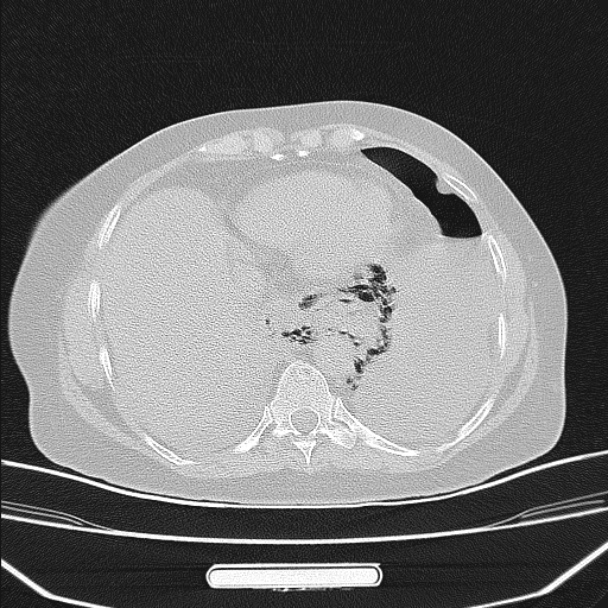 Boerhaave syndrome (Radiopaedia 45644-49799 Axial lung window 87).jpg