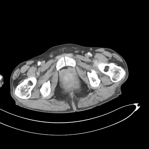 Bone metastasis from squamous cell carcinoma (Radiopaedia 30133-30730 B 80).jpg