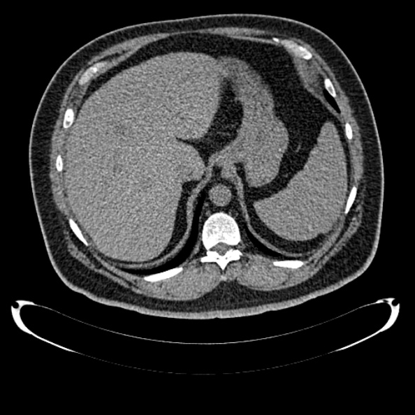 Bosniak renal cyst - type IV (Radiopaedia 24244-24518 Axial non-contrast 82).jpg