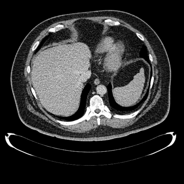 File:Bosniak renal cyst - type IV (Radiopaedia 24244-24518 C 27).jpg