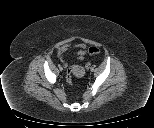 Bowel and splenic infarcts in acute lymphocytic leukemia (Radiopaedia 61055-68913 A 106).jpg