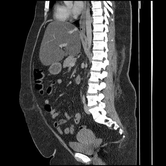 File:Bowel and splenic infarcts in acute lymphocytic leukemia (Radiopaedia 61055-68913 C 40).jpg