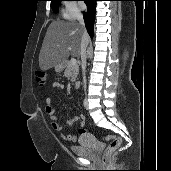 Bowel and splenic infarcts in acute lymphocytic leukemia (Radiopaedia 61055-68913 C 43).jpg