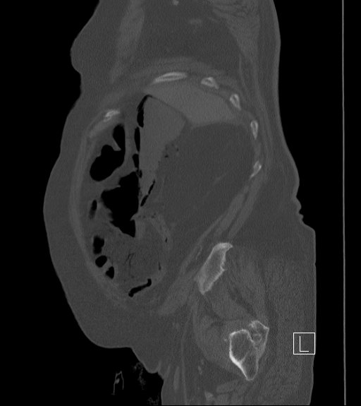 File:Bowel ischemia secondary to SMA occlusion with extensive portomesenteric venous gas (Radiopaedia 54656-60871 Sagittal bone window 97).jpg