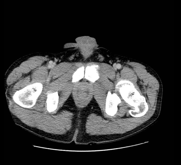 Bowel obstruction from colon carcinoma (Radiopaedia 22995-23028 A 88).jpg