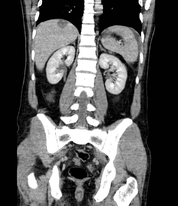 Bowel obstruction from colon carcinoma (Radiopaedia 22995-23028 C 52).jpg
