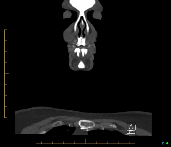 Brachiocephalic trunk stenosis (Radiopaedia 87242-103519 B 1).jpg