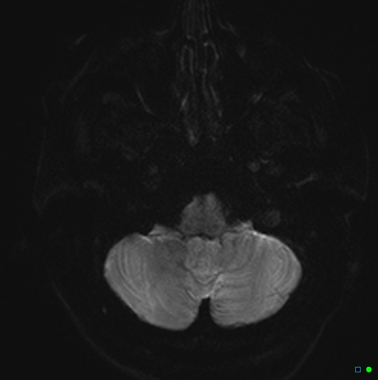 File:Brain death on MRI and CT angiography (Radiopaedia 42560-45689 Axial DWI 4).jpg