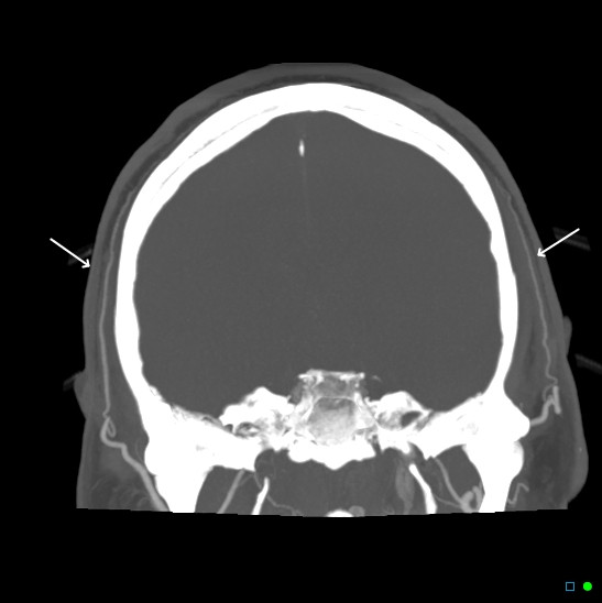 File:Brain death on MRI and CT angiography (Radiopaedia 42560-45841 A 1).jpg