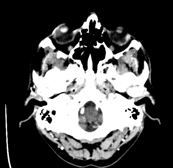 File:Brain metastases from lung cancer (Radiopaedia 24480-24781 Axial C+ delayed 3).jpg