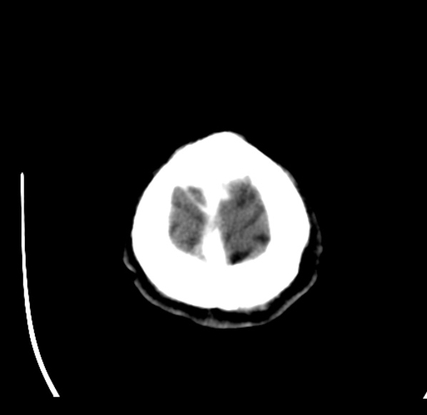 File:Brain metastases from lung cancer (Radiopaedia 24480-24781 Axial C+ delayed 61).jpg
