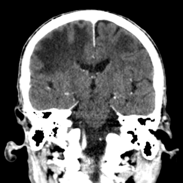Brain metastases from lung cancer (Radiopaedia 27849-28092 Coronal C+ delayed 35).jpg
