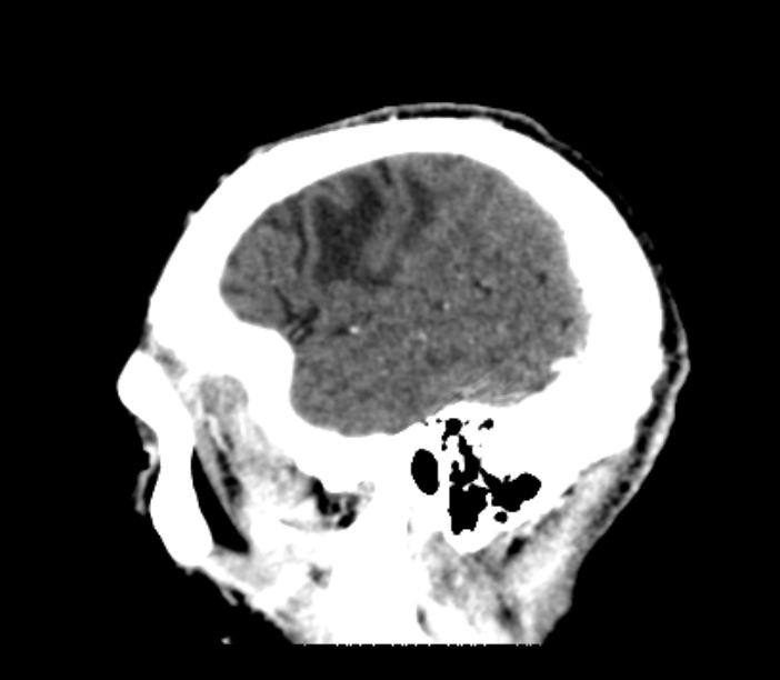 Brain metastases from lung cancer (Radiopaedia 27849-28092 Sagittal C+ delayed 11).jpg