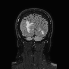 File:Brain metastases from lung cancer (Radiopaedia 83839-99028 Coronal FLAIR 73).jpg