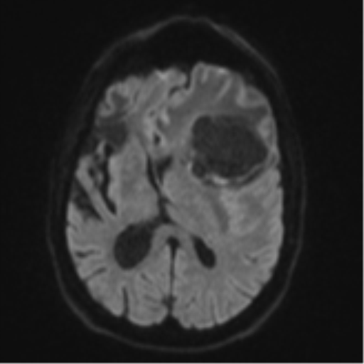 Brain metastasis (lung cancer) (Radiopaedia 48289-53179 Axial DWI 43).png