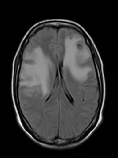 File:Brain metastasis as initial presentation of non-small cell lung cancer (Radiopaedia 65122-74126 Axial FLAIR 12).jpg