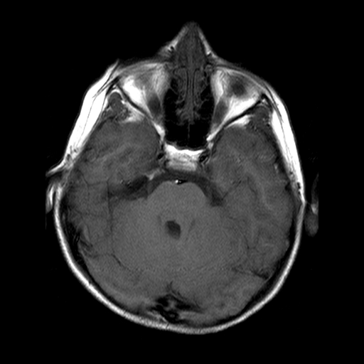 File:Brainstem ganglioglioma (Radiopaedia 10763-11224 Axial T1 14).jpg