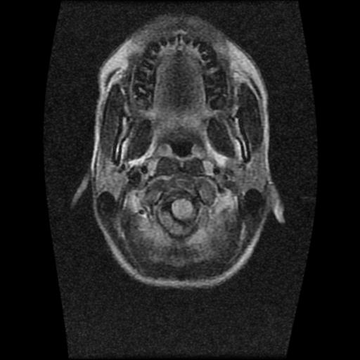 File:Brainstem glioma (Radiopaedia 30923-31624 Axial FLAIR 1).jpg
