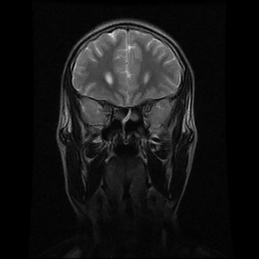 File:Brainstem glioma (Radiopaedia 30923-31624 Coronal T2 15).jpg