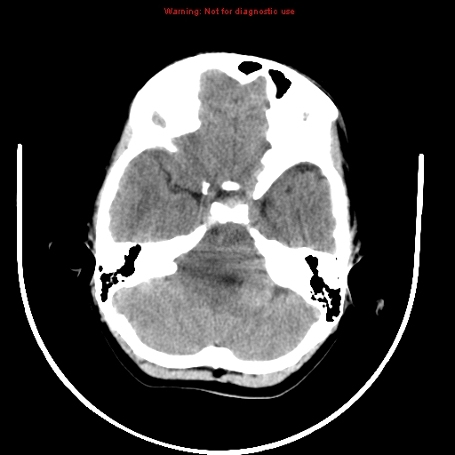 File:Brainstem glioma (Radiopaedia 9444-10123 non-contrast 4).jpg