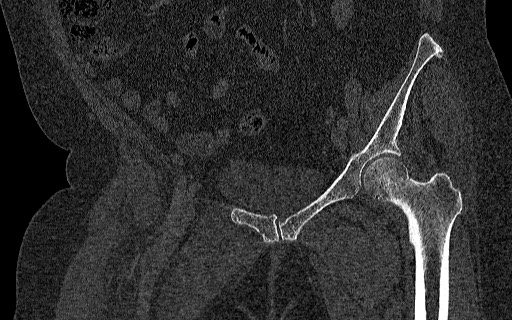 File:Breast carcinoma with pathological hip fracture (Radiopaedia 60314-67993 Coronal bone window 59).jpg