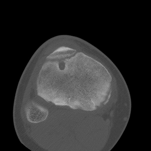 Brodie abscess of the tibia (Radiopaedia 58984-66250 Axial bone window 70).jpg