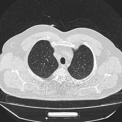 File:Bronchial atresia (Radiopaedia 58271-65417 Axial lung window 6).jpg