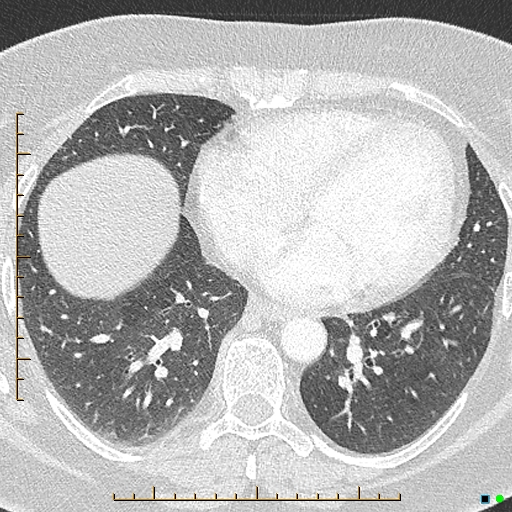 File:Bronchial diverticula (Radiopaedia 79512-92676 Axial lung window 137).jpg