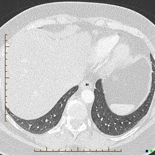 Bronchial diverticula (Radiopaedia 79512-92676 Axial lung window 174).jpg