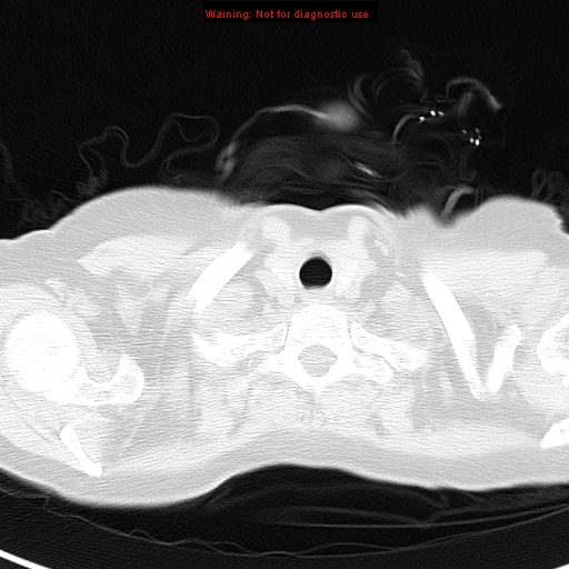 File:Bronchoalveolar carcinoma (BAC) (Radiopaedia 13436-13392 Axial lung window 1).jpg