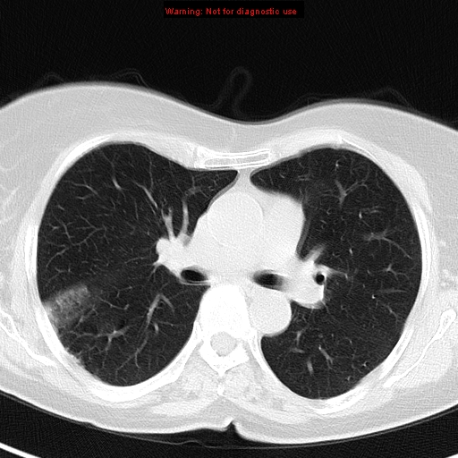 File:Bronchoalveolar carcinoma (BAC) (Radiopaedia 13436-13392 Axial lung window 23).jpg